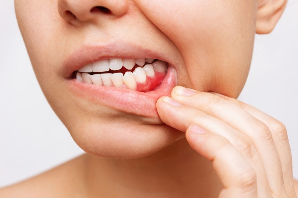 Close-up of a person pulling down their lower lip to reveal red, inflamed gums around the teeth, indicating signs of gum disease or gingivitis.