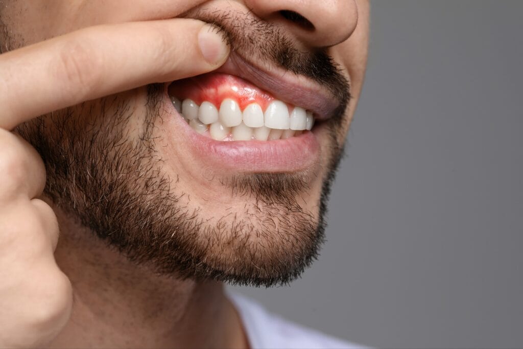 Close-up of a man pulling up his upper lip to reveal red, swollen gums above his front teeth, indicating a possible gum injury or inflammation.