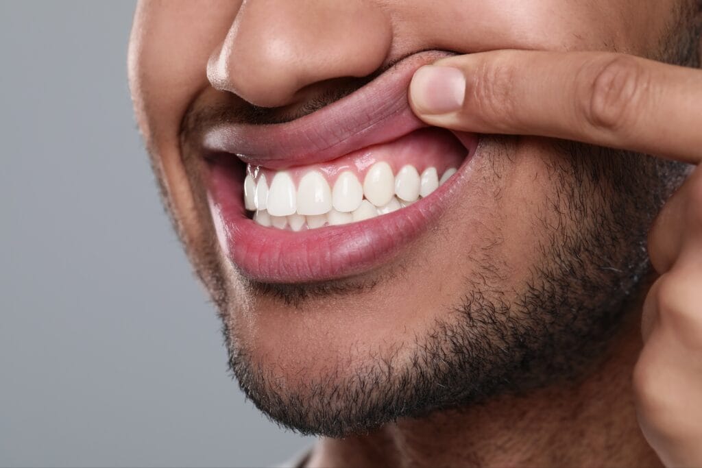 Close-up of a smiling man pulling up his upper lip to reveal healthy gums and straight white teeth, highlighting a gummy smile.