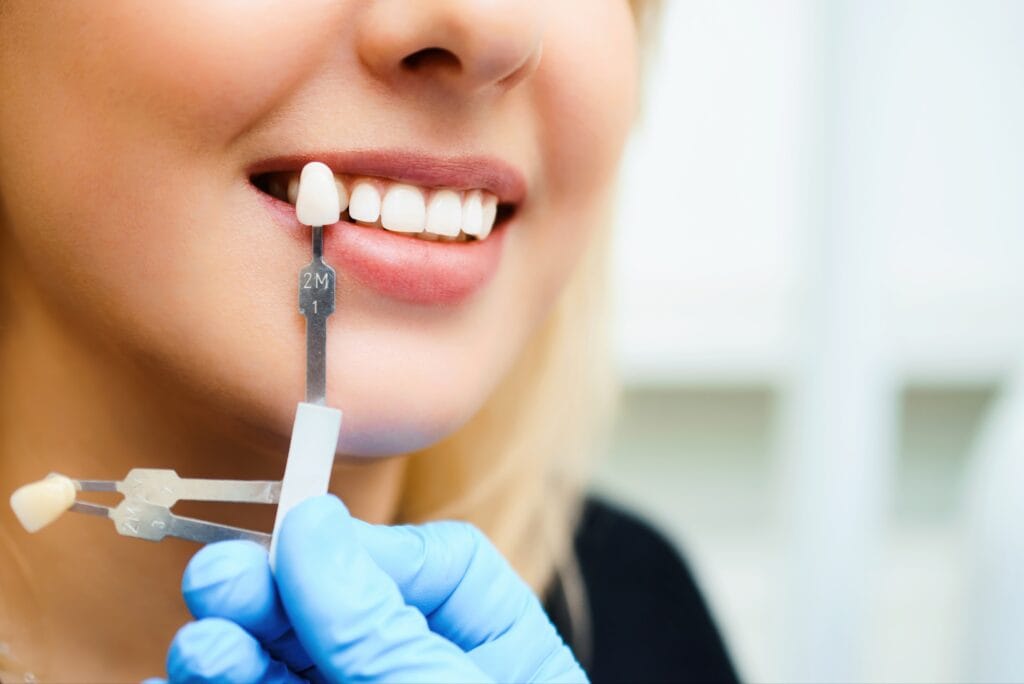 Close-up of a smiling woman having her tooth shade matched with a dental shade guide for a teeth whitening procedure.